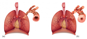 Normal (a) ve astımlı akciğer (b) yapısı