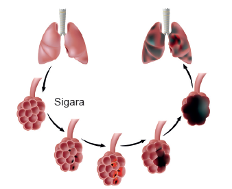 Sigara nedeniyle akciğer alveol yapısının bozulması