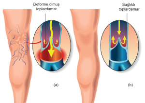 Varis oluşmuş bacak (a) ile sağlıklı bacakta (b) toplardamar durumları